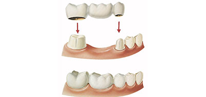 3 Unit Dental Bridge | Whites Dental