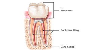 canal stage three | Whites Dental