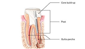 canal stage two | Whites Dental