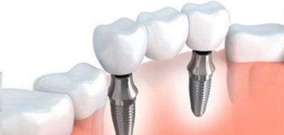 Dental Implant | Whites Dental