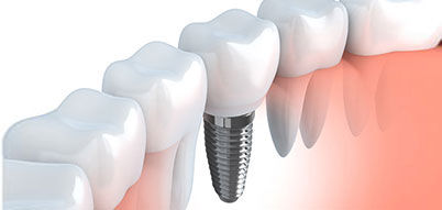 Dental Implant | Whites Dental