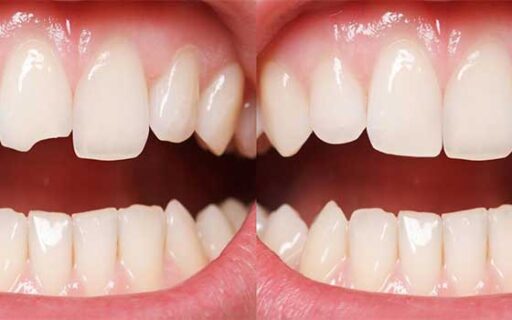 Composite Bonding | Whites Dental