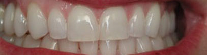 A close up of composite bonding image after treatment