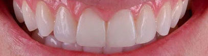 Close up image of porcelain veneers after treatment