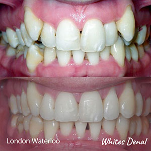 removable braces london bridge orthodontic braces & iInvisalign in london | Whites Dental