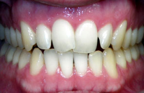 Orthodontist in London Waterloo | Whites Dental