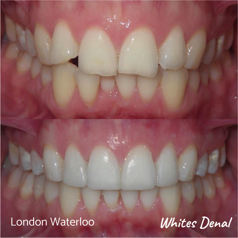 Fixed dental braces before after | Orthodontist in London Waterloo 3 | Whites Dental