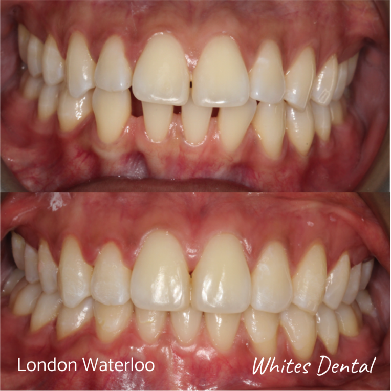 Fixed dental braces before after | Orthodontist in London Waterloo 7 | Whites Dental