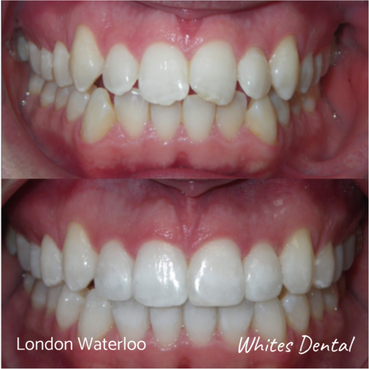 photo showing top and bottom row of teeth - before and after braces. Irregular teeth transformed into a straight smile.