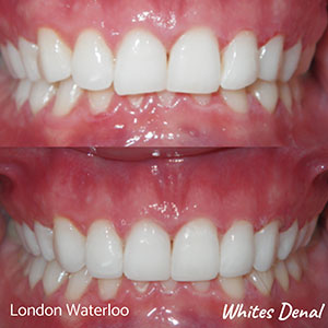 fixed braces Before And After | Cosmetic Dentist in London Waterloo | Whites Dental