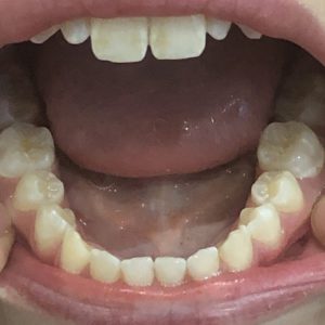 Invisalign Consultation | Whites Dental