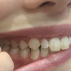 Invisalign Consultation | Whites Dental