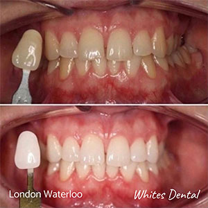 four ways cosmetic dentistry can improve your smile in london waterloo cosmetic dentist in london | Whites Dental