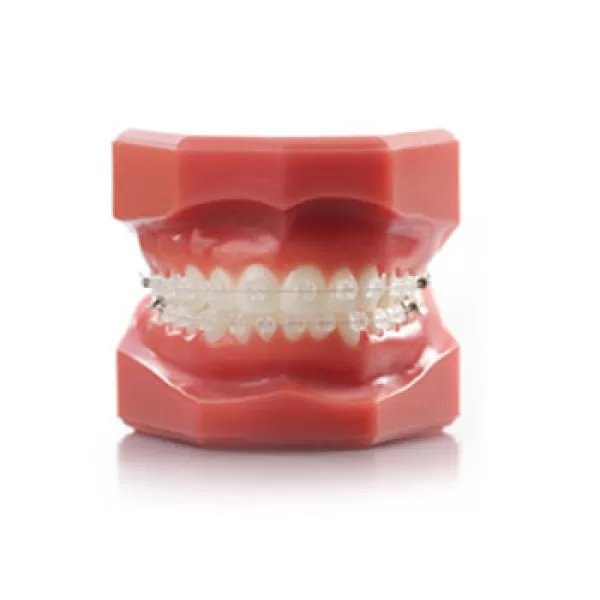 Photo of Fixed Braces demonstrated on dental model | Whites Dental