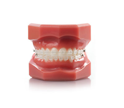 Photo of Fixed Braces demonstrated on dental model | Whites Dental