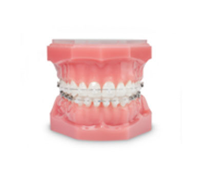 photo of fixed braces with ceramic brackets