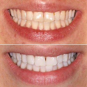 cosmetic dentist teeth whitening in london | Whites Dental