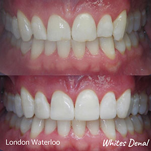 can veneers fall off cosmetic dentist in london | Whites Dental