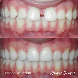 can you still get cavities with veneers orthodontist in london | Whites Dental