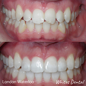 Can braces work in 6 months orthodontist in london | Whites Dental