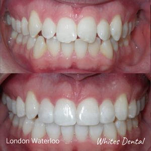 Can You Request To Get Your Braces Taken Off Early | Orthodontist in London Waterloo | Whites Dental