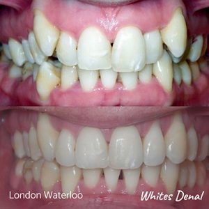 Do braces make your teeth yellow | Orthodontist in London Waterloo | Whites Dental