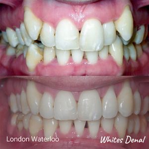 What is the cheapest cost of braces | Orthodontist in London Waterloo | Whites Dental