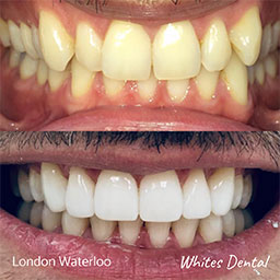 Is it too late to straighten my teeth | Orthodontist in London Waterloo | Whites Dental