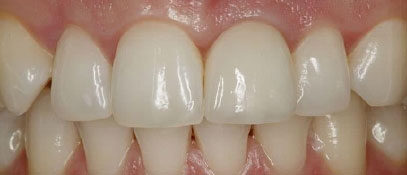 Teeth Alignment | Whites Dental