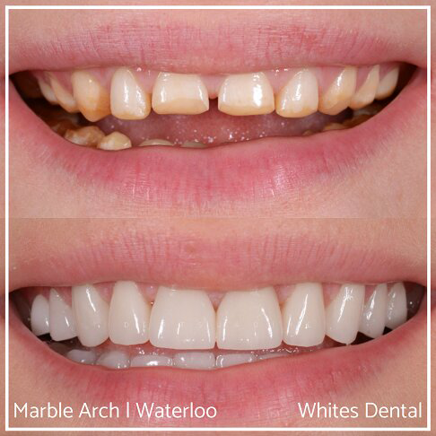 Orthodontist In London Waterloo | Whites Dental