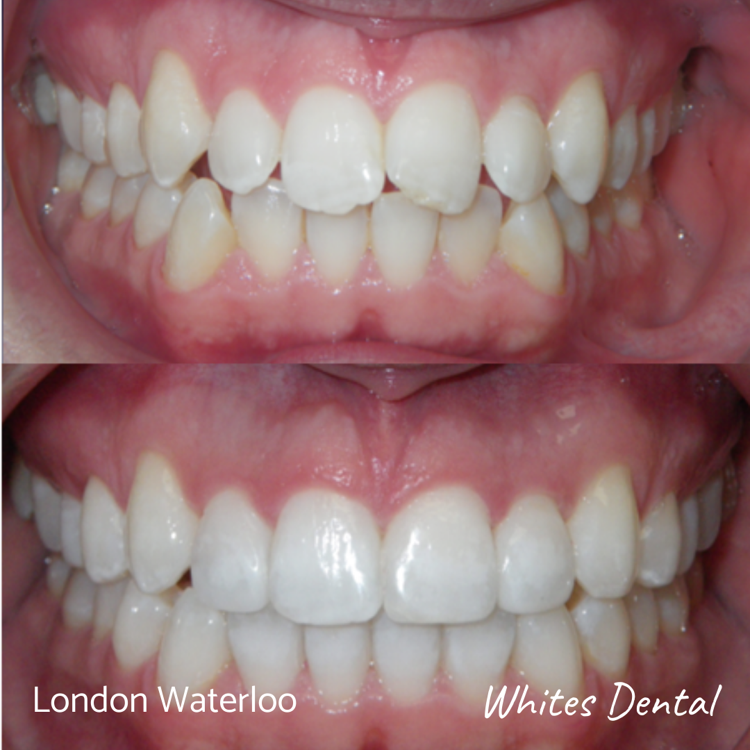 Orthodontic Braces & Invisalign In London | Whites Dental