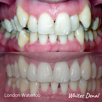 Orthodontic Braces & Invisalign In London | Whites Dental