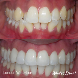 Do Braces Change Your Voice | Orthodontics in London Waterloo | Whites Dental