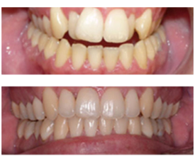 Orthodontist in London Waterloo | Whites Dental