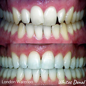 Orthodontic braces London | Whites Dental