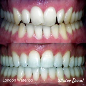 Are Braces Painful | Fixed Braces in London Waterloo | Whites Dental