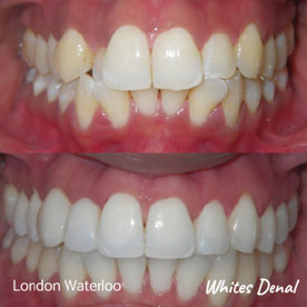 What are the quickest braces | Whites Dental