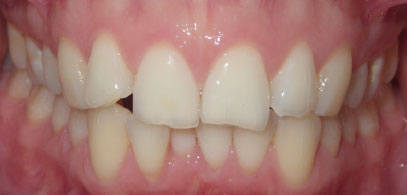 Patient’s teeth prior to Invisalign in London. Invisalign consultation was free for the patient. First case.