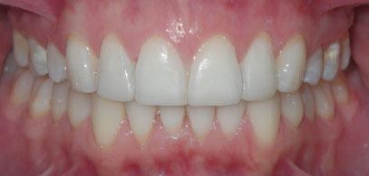 Patient’s teeth after Invisalign & composite bonding in London. Invisalign consultation was free for the patient. First case