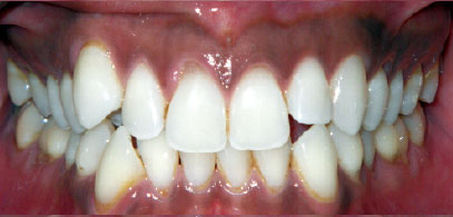 Patient’s teeth prior to Invisalign in London. Invisalign consultation was free for the patient. Second case