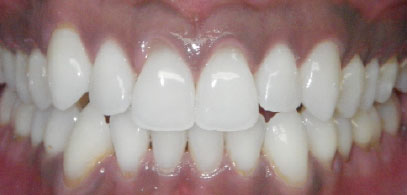 Patient’s teeth after Invisalign in London. Invisalign consultation was free for the patient. Second case