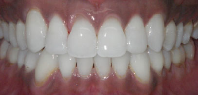 Patient’s teeth after Invisalign & composite bonding in London. Invisalign consultation was free for the patient. Second case