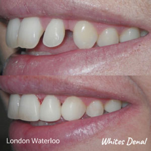 what are the quickest braces london | Whites Dental