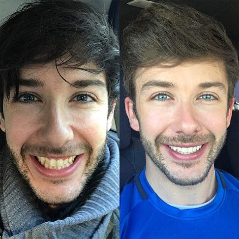 photo of young man before and after braces - front view