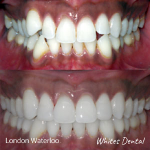 Can you feel teeth shifting with braces in london | Whites Dental