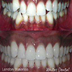 orthodontist london waterloo | Fixed Braces in London | Whites Dental