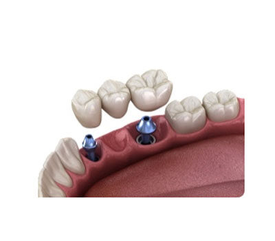 Dental Implant London Waterloo | Whites Dental