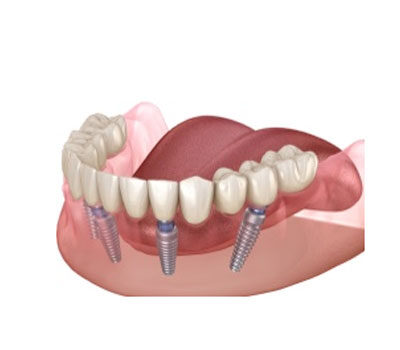 Dental Implant London Waterloo | Whites Dental