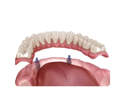 Dental Implant London Waterloo | Whites Dental