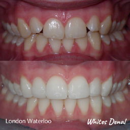 cosmetic dentist in london waterloo | Whites Dental